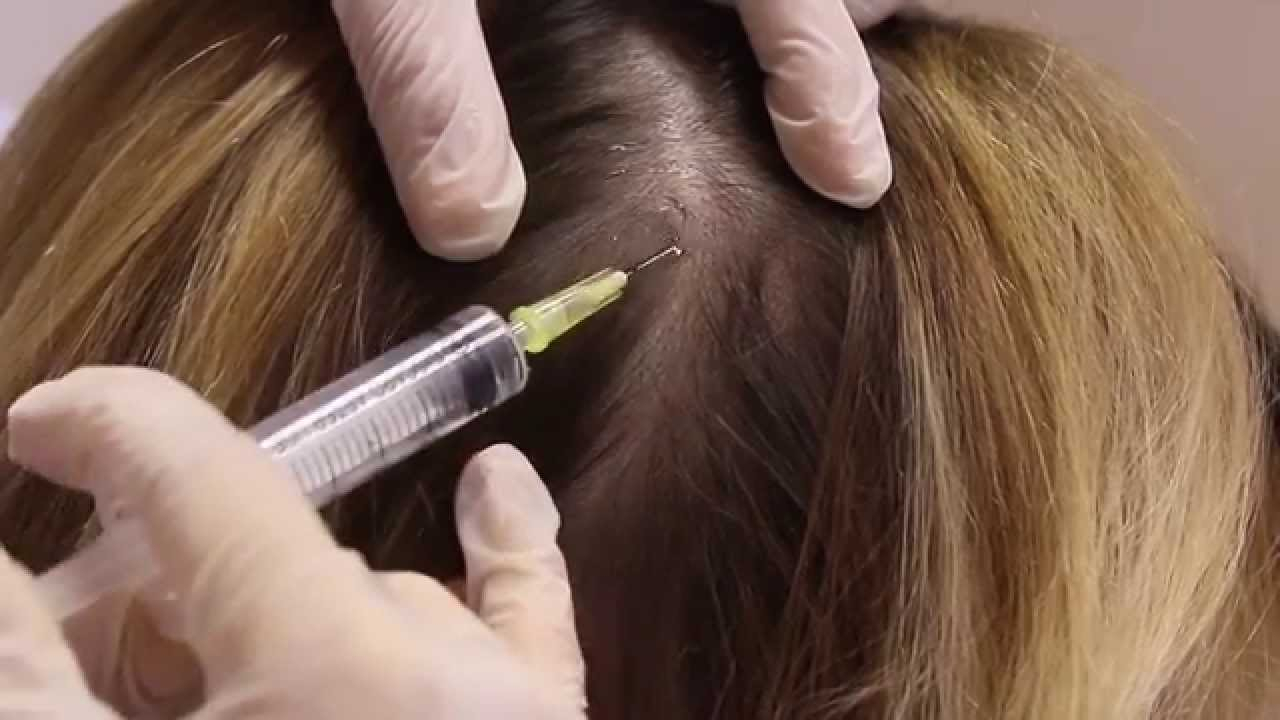 The Truth about PRP Injections  Buckhead Hair Restoration  Dr Slater