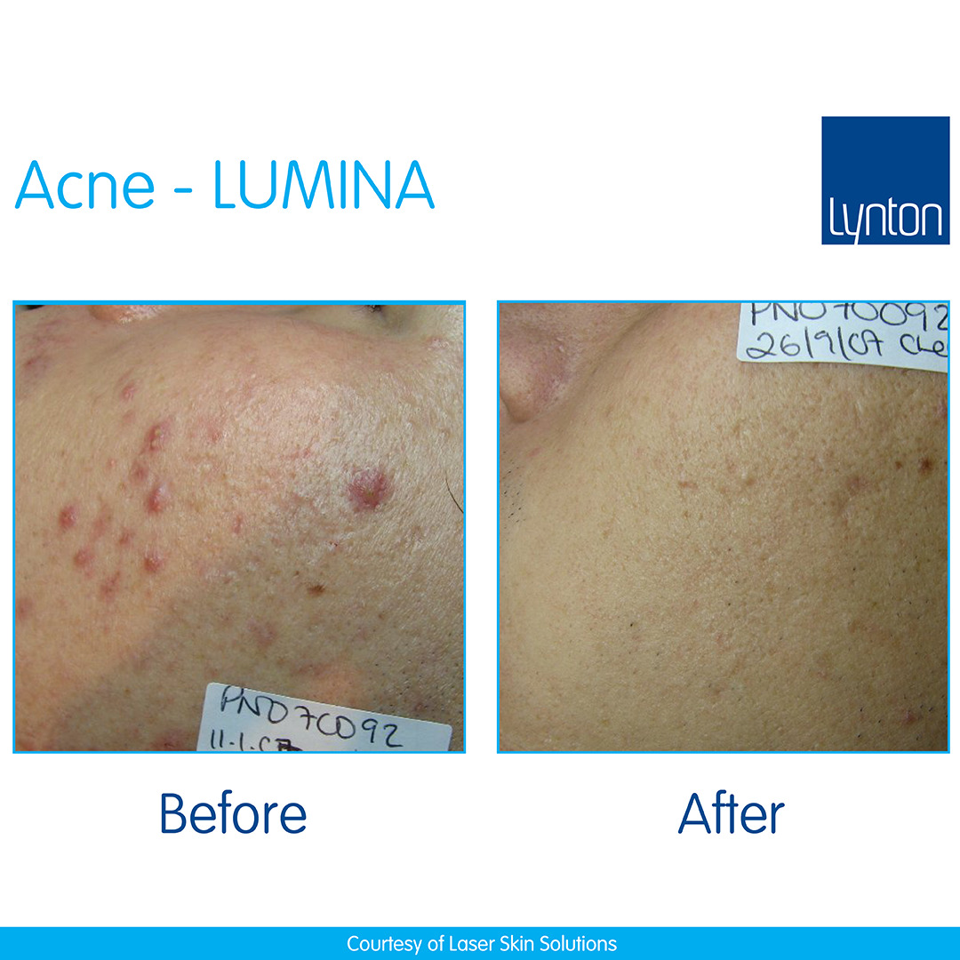 Lumina-B-&-A-Acne---Laser-Skin-Solutions-