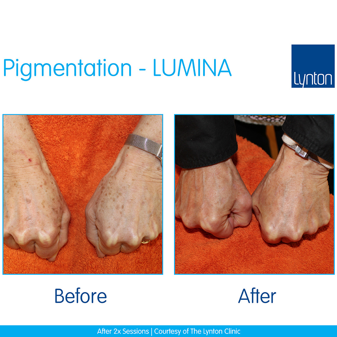 Lumina-B-&-A-Hand-Pigmentation---The-Lynton-Clinic-
