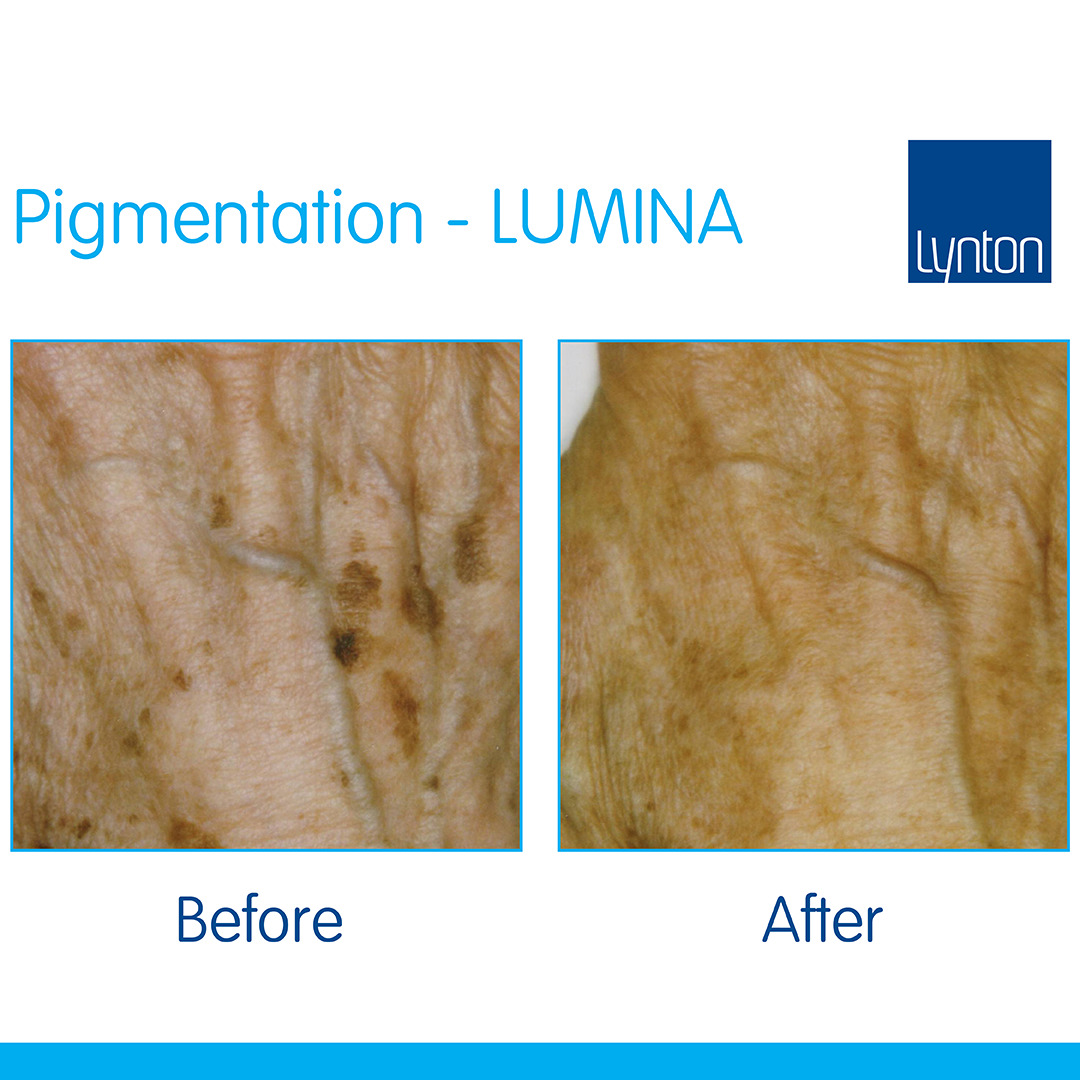 Lumina-B-&-A-Pigmentation---The-Lynton-Clinic-