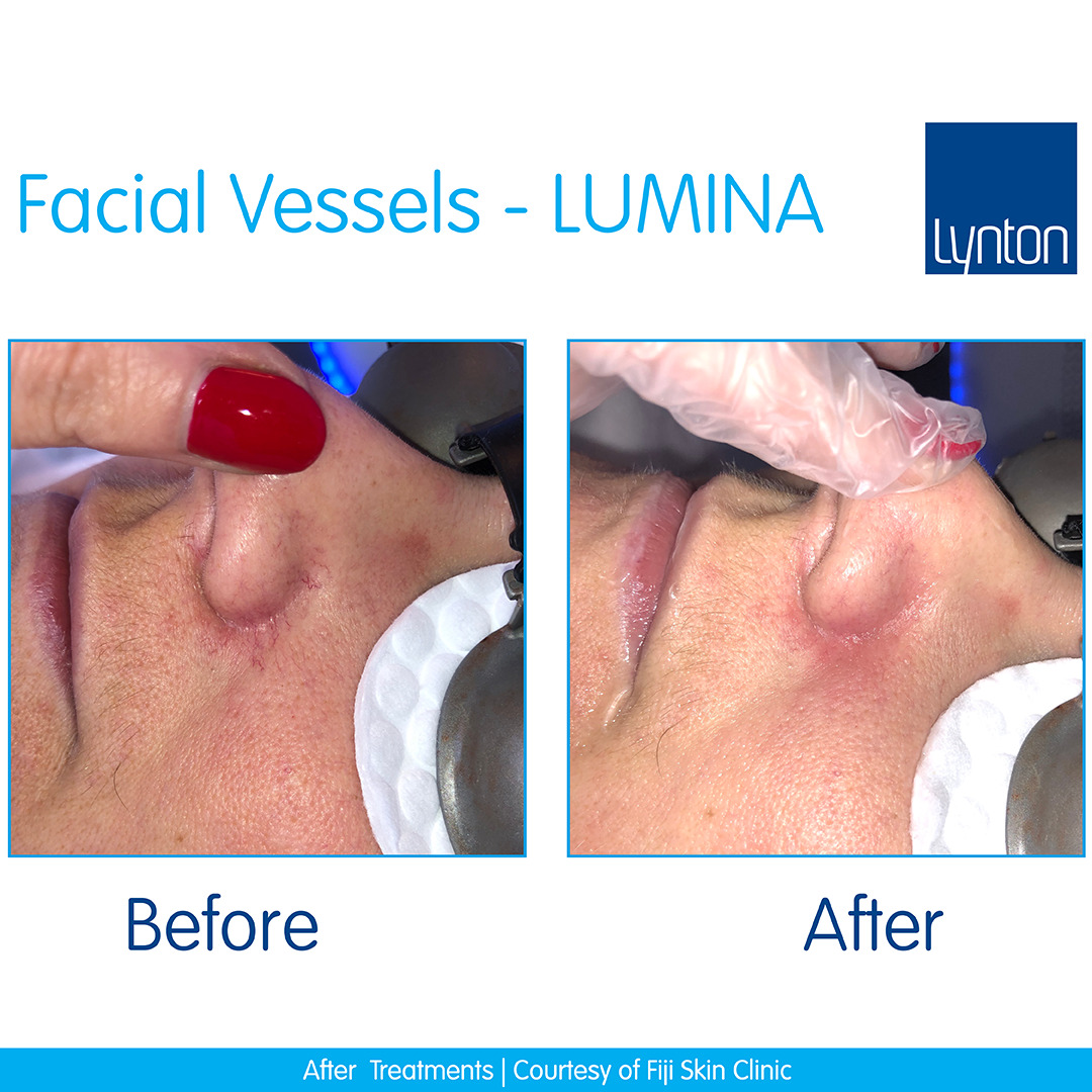 Lumina-Facial-Vessels-Fiji-Skin-Clinic