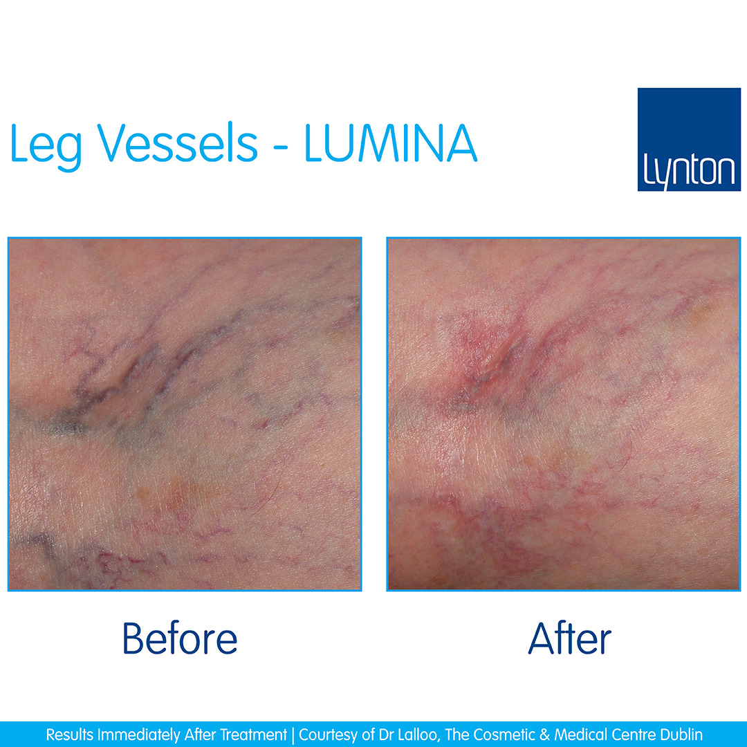 Lumina-Leg-Vessels-Cosmetic-&-Medical-Centre-Dublin